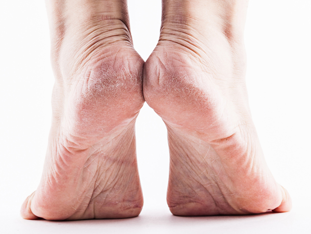 Psoriasis